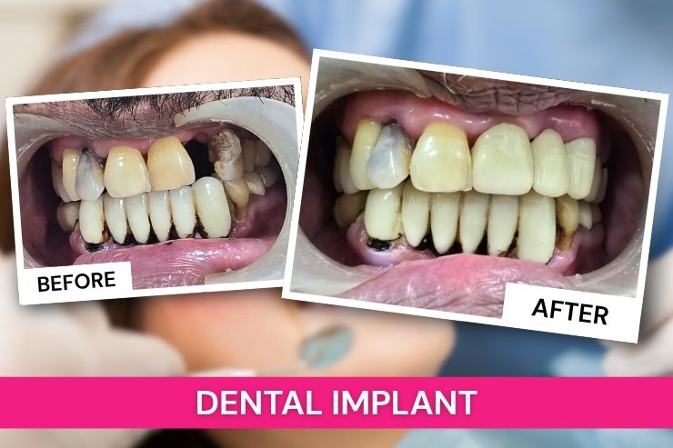 implant