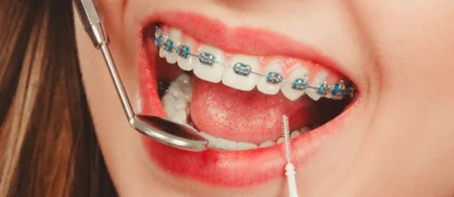 braces treatment in swawlambi nagar