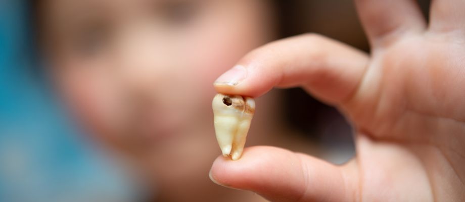 5 Unknown Risks of Untreated Tooth Decay