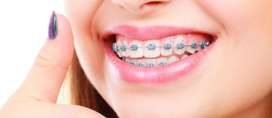 Braces treatment why and when