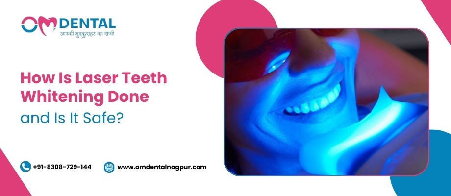 Teeth Whitening Treatment