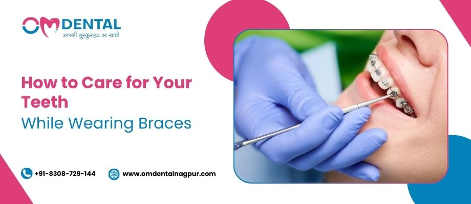 Braces Treatment