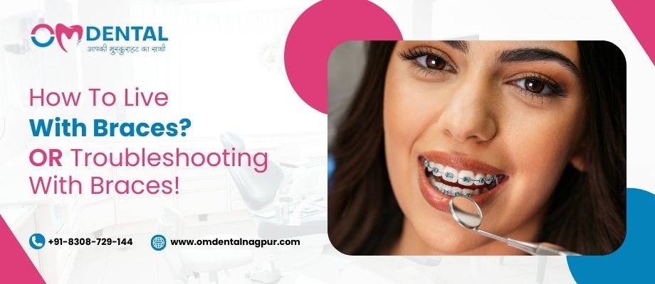 How to Live With Braces? OR Troubleshooting with Braces!!