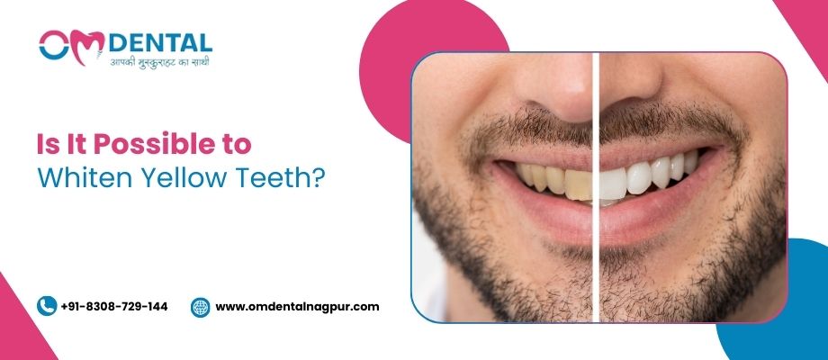 teeth whitening treatment in trimurti nagar