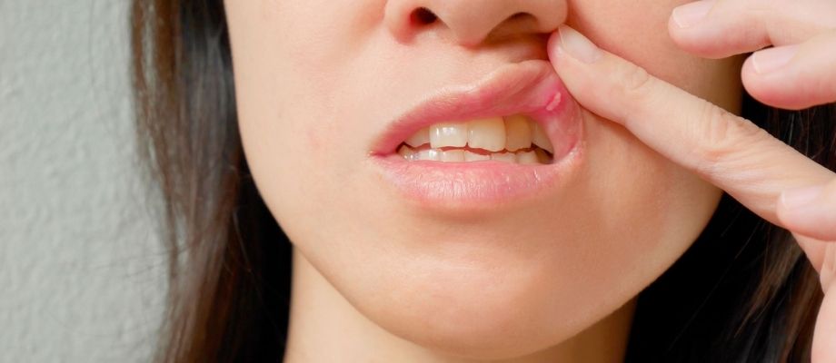 Oral Ulcer