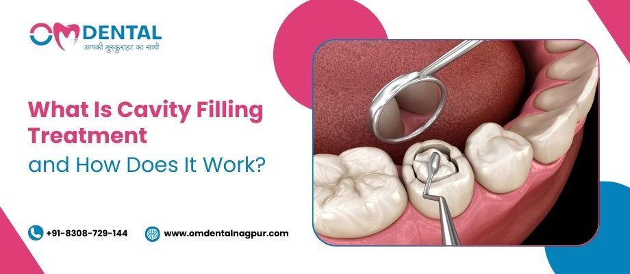 cavity filling treatment in trimurti nagar